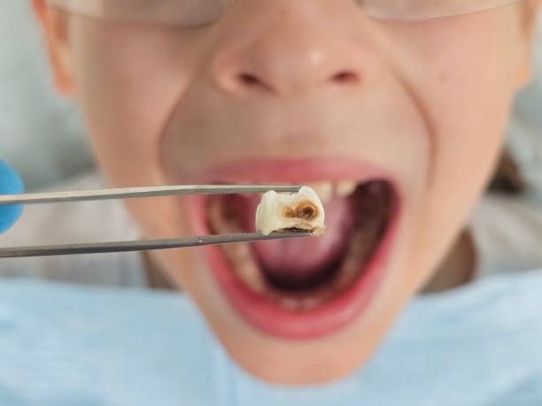 Best Chipped Tooth Repair Near Me  in West Carrollton, OH